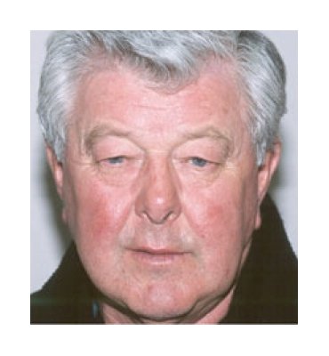 Facial Rejuvenation Surgery & Treatments Before